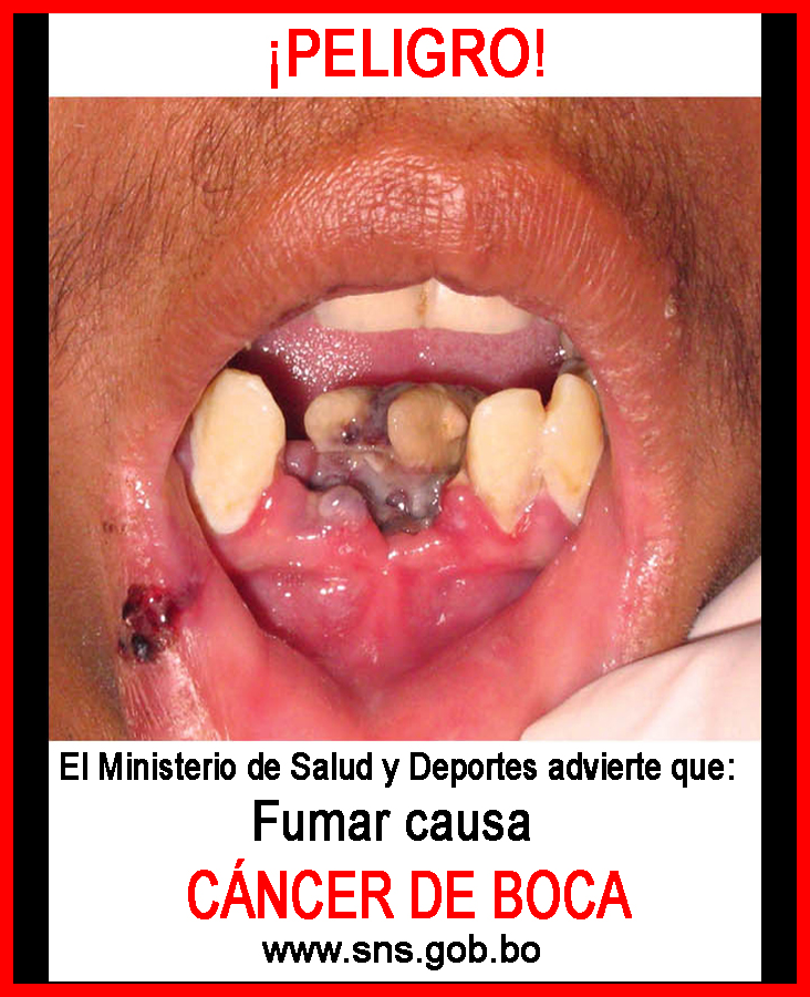 Bolivia 2011 Health Effects mouth - diseased organ, oral cancer, gross